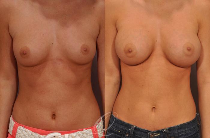 Breast Augmentation Case 257 Before & After View #1 | Serving Rochester, Syracuse & Buffalo, NY | Quatela Center for Plastic Surgery