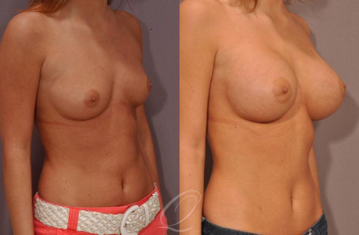 Breast Augmentation Case 257 Before & After View #2 | Serving Rochester, Syracuse & Buffalo, NY | Quatela Center for Plastic Surgery