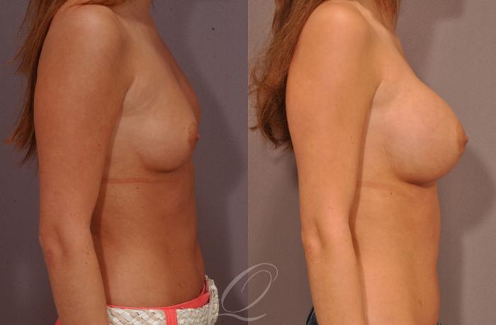 Breast Augmentation Case 257 Before & After View #3 | Serving Rochester, Syracuse & Buffalo, NY | Quatela Center for Plastic Surgery