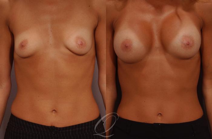 Breast Augmentation Case 259 Before & After View #1 | Serving Rochester, Syracuse & Buffalo, NY | Quatela Center for Plastic Surgery