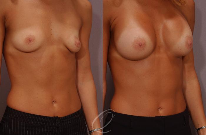 Breast Augmentation Case 259 Before & After View #2 | Serving Rochester, Syracuse & Buffalo, NY | Quatela Center for Plastic Surgery