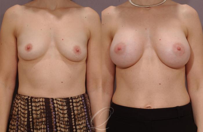 Breast Augmentation Case 260 Before & After View #1 | Serving Rochester, Syracuse & Buffalo, NY | Quatela Center for Plastic Surgery