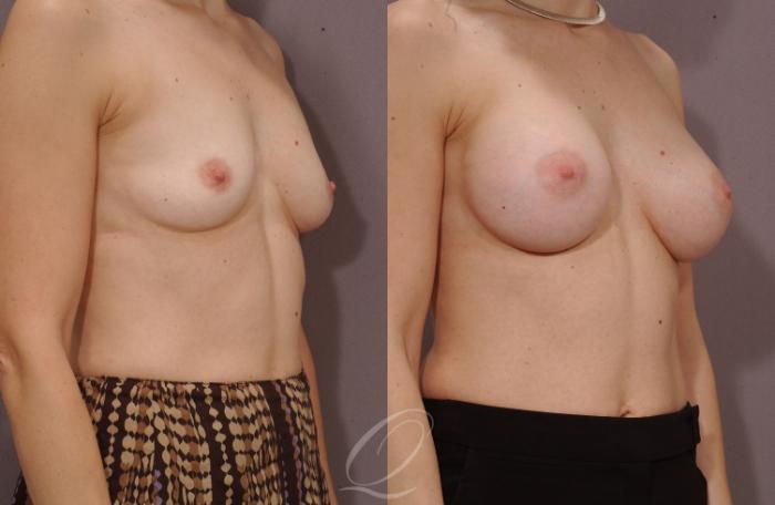 Breast Augmentation Case 260 Before & After View #2 | Serving Rochester, Syracuse & Buffalo, NY | Quatela Center for Plastic Surgery