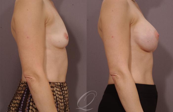 Breast Augmentation Case 260 Before & After View #3 | Serving Rochester, Syracuse & Buffalo, NY | Quatela Center for Plastic Surgery