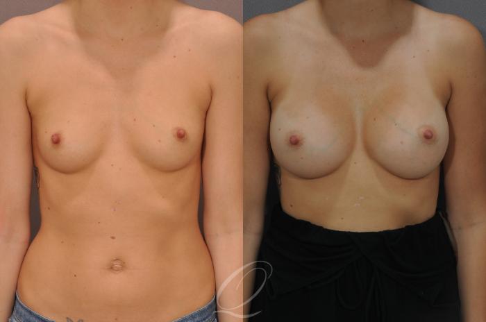 Breast Augmentation Case 262 Before & After View #1 | Serving Rochester, Syracuse & Buffalo, NY | Quatela Center for Plastic Surgery