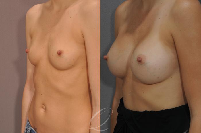 Breast Augmentation Case 262 Before & After View #2 | Serving Rochester, Syracuse & Buffalo, NY | Quatela Center for Plastic Surgery