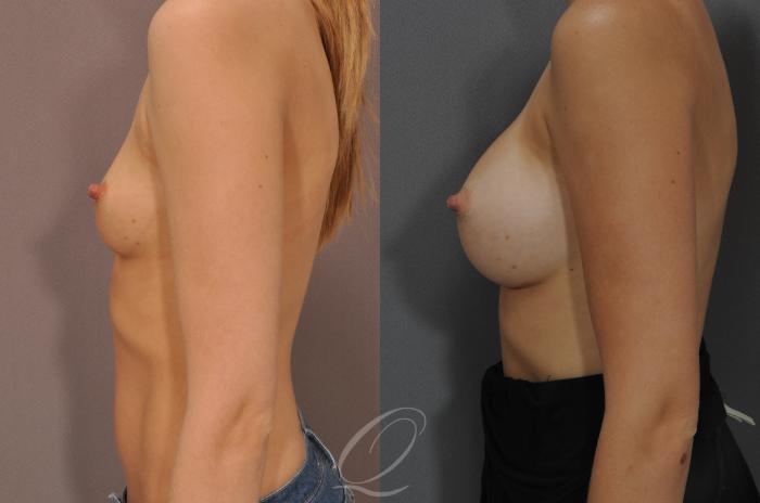 Breast Augmentation Case 262 Before & After View #3 | Serving Rochester, Syracuse & Buffalo, NY | Quatela Center for Plastic Surgery