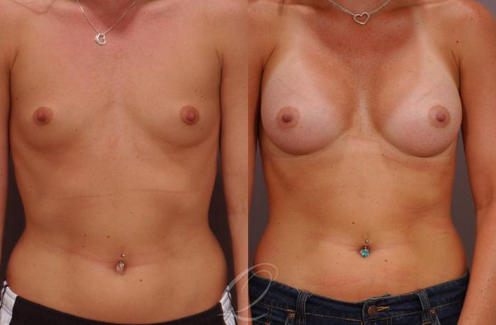 Breast Augmentation Case 264 Before & After View #1 | Serving Rochester, Syracuse & Buffalo, NY | Quatela Center for Plastic Surgery