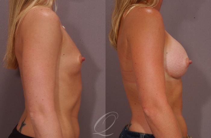 Breast Augmentation Case 264 Before & After View #3 | Serving Rochester, Syracuse & Buffalo, NY | Quatela Center for Plastic Surgery
