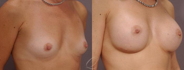 Breast Augmentation Case 265 Before & After View #2 | Serving Rochester, Syracuse & Buffalo, NY | Quatela Center for Plastic Surgery