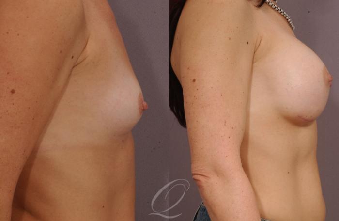 Breast Augmentation Case 265 Before & After View #3 | Serving Rochester, Syracuse & Buffalo, NY | Quatela Center for Plastic Surgery