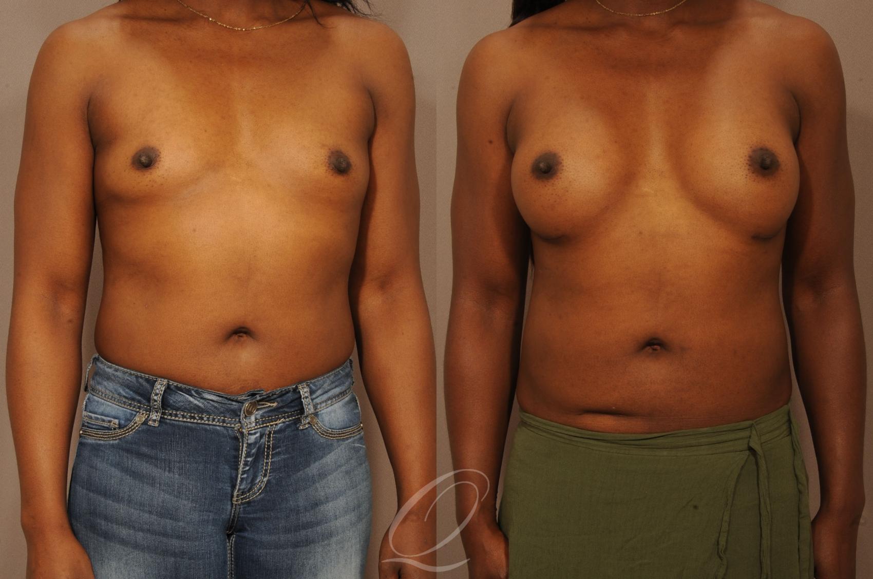 Breast Augmentation Case 276 Before & After View #1 | Serving Rochester, Syracuse & Buffalo, NY | Quatela Center for Plastic Surgery