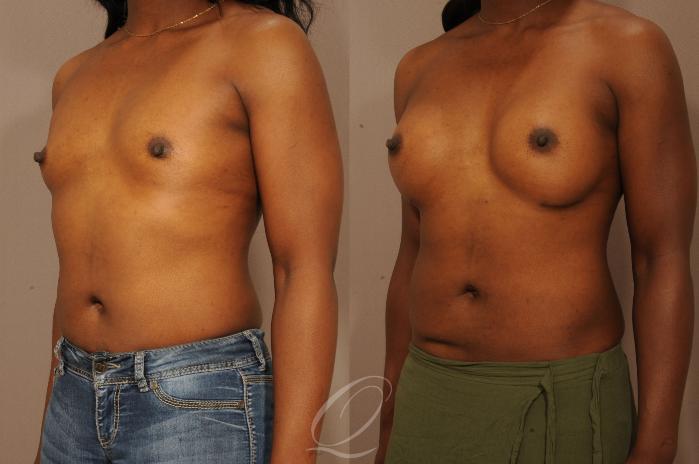 Breast Augmentation Case 276 Before & After View #2 | Serving Rochester, Syracuse & Buffalo, NY | Quatela Center for Plastic Surgery