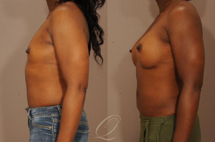Breast Augmentation Case 276 Before & After View #3 | Serving Rochester, Syracuse & Buffalo, NY | Quatela Center for Plastic Surgery