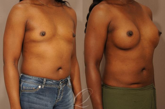 Breast Augmentation Case 276 Before & After View #4 | Serving Rochester, Syracuse & Buffalo, NY | Quatela Center for Plastic Surgery
