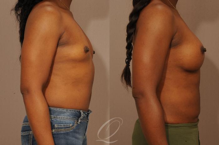 Breast Augmentation Case 276 Before & After View #5 | Serving Rochester, Syracuse & Buffalo, NY | Quatela Center for Plastic Surgery