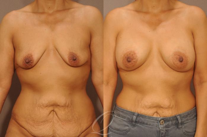 Breast Augmentation Case 277 Before & After View #1 | Serving Rochester, Syracuse & Buffalo, NY | Quatela Center for Plastic Surgery
