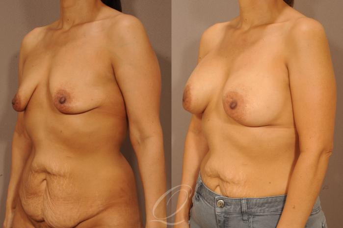 Breast Augmentation Case 277 Before & After View #2 | Serving Rochester, Syracuse & Buffalo, NY | Quatela Center for Plastic Surgery