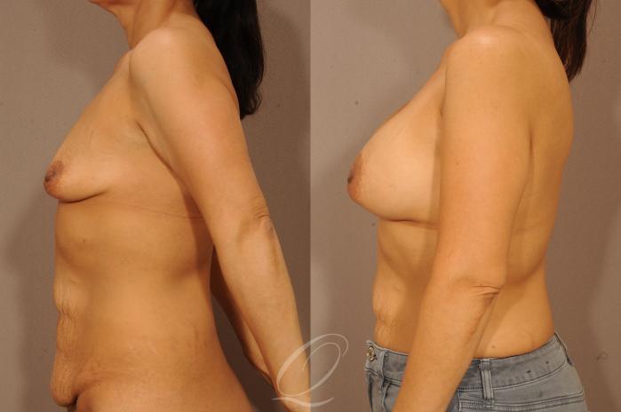 Breast Augmentation Case 277 Before & After View #3 | Serving Rochester, Syracuse & Buffalo, NY | Quatela Center for Plastic Surgery