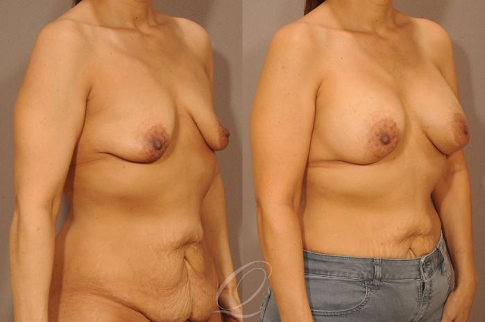 Breast Augmentation Case 277 Before & After View #4 | Serving Rochester, Syracuse & Buffalo, NY | Quatela Center for Plastic Surgery