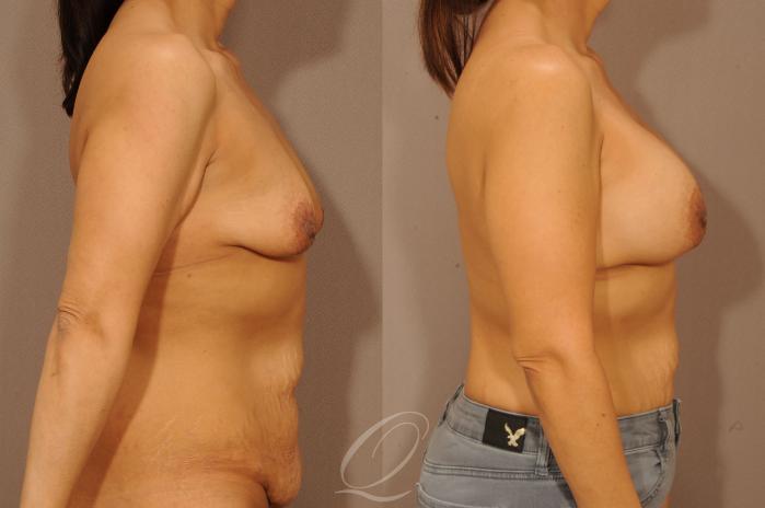 Breast Augmentation Case 277 Before & After View #5 | Serving Rochester, Syracuse & Buffalo, NY | Quatela Center for Plastic Surgery