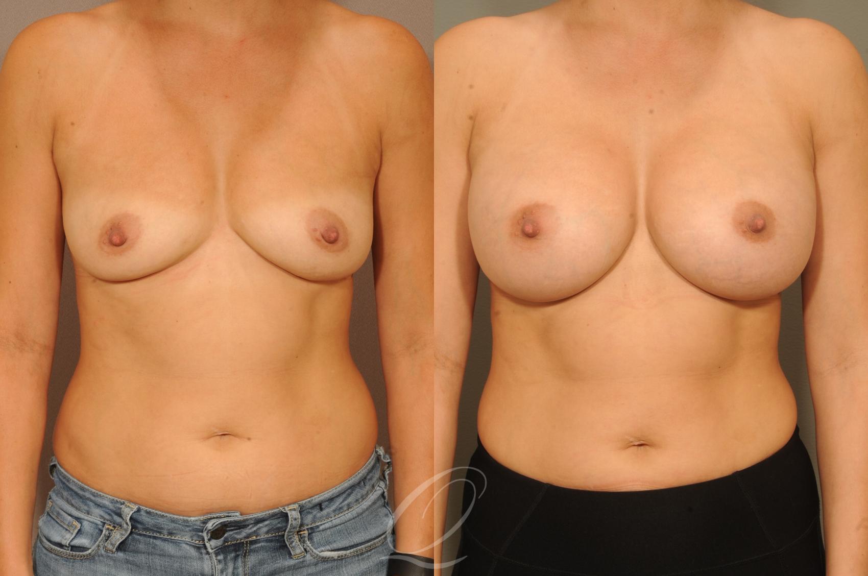 Breast Augmentation Case 299 Before & After View #1 | Serving Rochester, Syracuse & Buffalo, NY | Quatela Center for Plastic Surgery