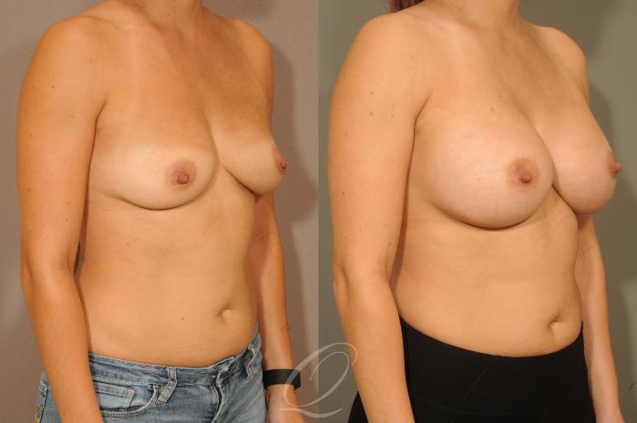 Breast Augmentation Case 299 Before & After View #2 | Serving Rochester, Syracuse & Buffalo, NY | Quatela Center for Plastic Surgery