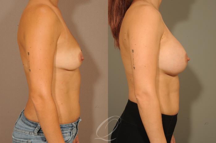 Breast Augmentation Case 299 Before & After View #3 | Serving Rochester, Syracuse & Buffalo, NY | Quatela Center for Plastic Surgery