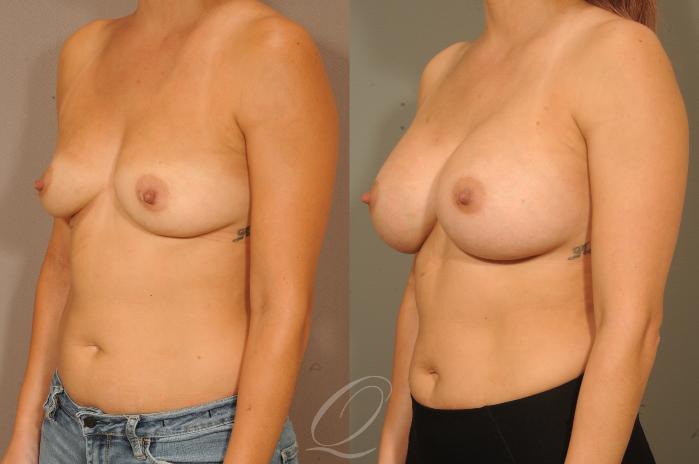 Breast Augmentation Case 299 Before & After View #4 | Serving Rochester, Syracuse & Buffalo, NY | Quatela Center for Plastic Surgery