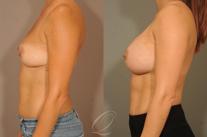 Breast Augmentation Case 299 Before & After View #5 | Serving Rochester, Syracuse & Buffalo, NY | Quatela Center for Plastic Surgery