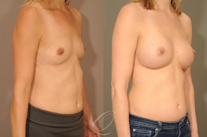 Breast Augmentation Case 300 Before & After View #2 | Serving Rochester, Syracuse & Buffalo, NY | Quatela Center for Plastic Surgery
