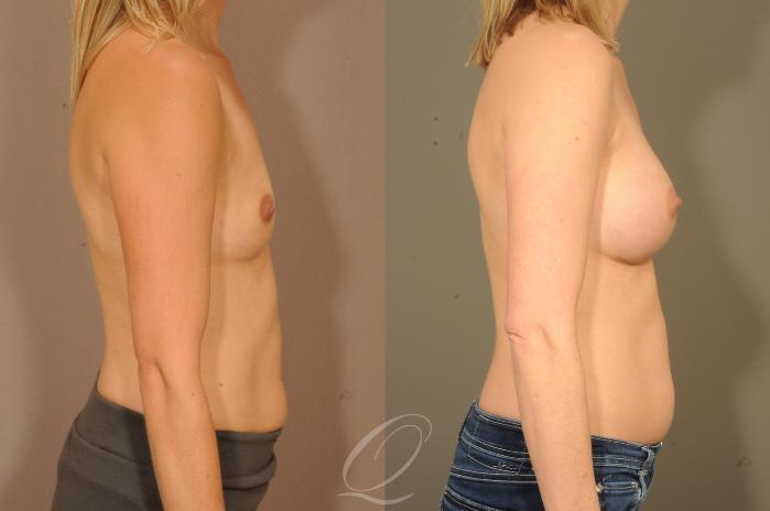 Breast Augmentation Case 300 Before & After View #3 | Serving Rochester, Syracuse & Buffalo, NY | Quatela Center for Plastic Surgery