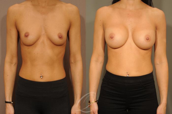 Breast Augmentation Case 310 Before & After View #1 | Serving Rochester, Syracuse & Buffalo, NY | Quatela Center for Plastic Surgery