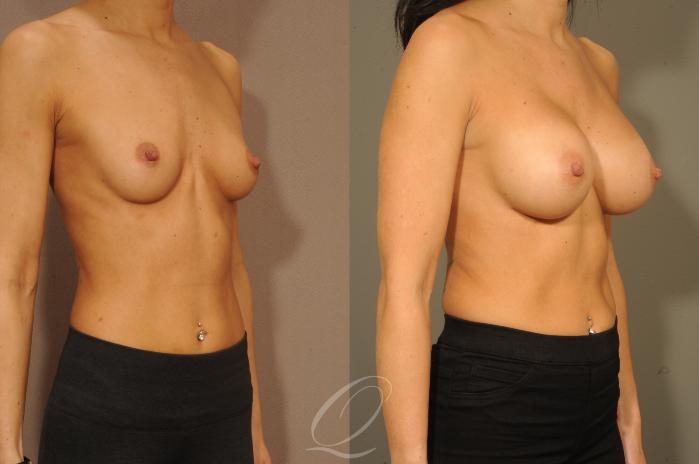 Breast Augmentation Case 310 Before & After View #2 | Serving Rochester, Syracuse & Buffalo, NY | Quatela Center for Plastic Surgery