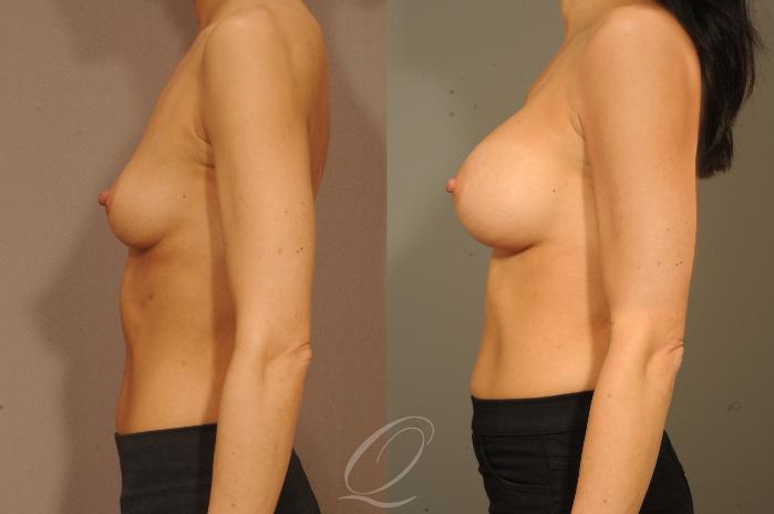 Breast Augmentation Case 310 Before & After View #5 | Serving Rochester, Syracuse & Buffalo, NY | Quatela Center for Plastic Surgery