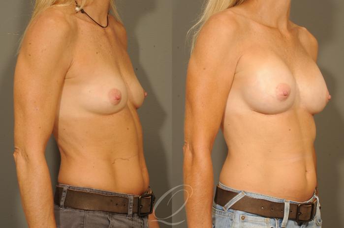 Breast Augmentation Case 315 Before & After View #2 | Serving Rochester, Syracuse & Buffalo, NY | Quatela Center for Plastic Surgery