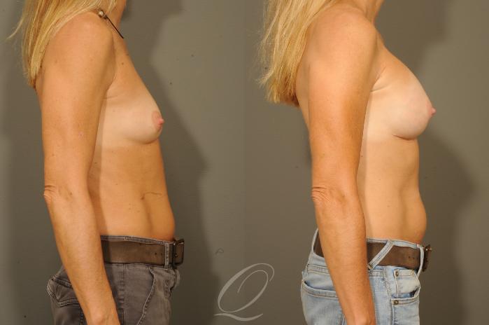 Breast Augmentation Case 315 Before & After View #3 | Serving Rochester, Syracuse & Buffalo, NY | Quatela Center for Plastic Surgery