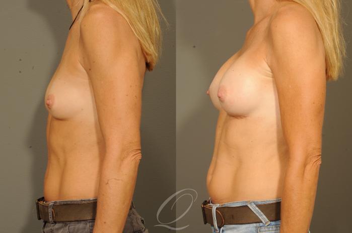 Breast Augmentation Case 315 Before & After View #5 | Serving Rochester, Syracuse & Buffalo, NY | Quatela Center for Plastic Surgery