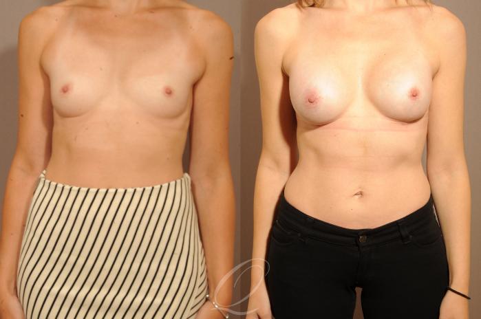Breast Augmentation Case 317 Before & After View #1 | Serving Rochester, Syracuse & Buffalo, NY | Quatela Center for Plastic Surgery