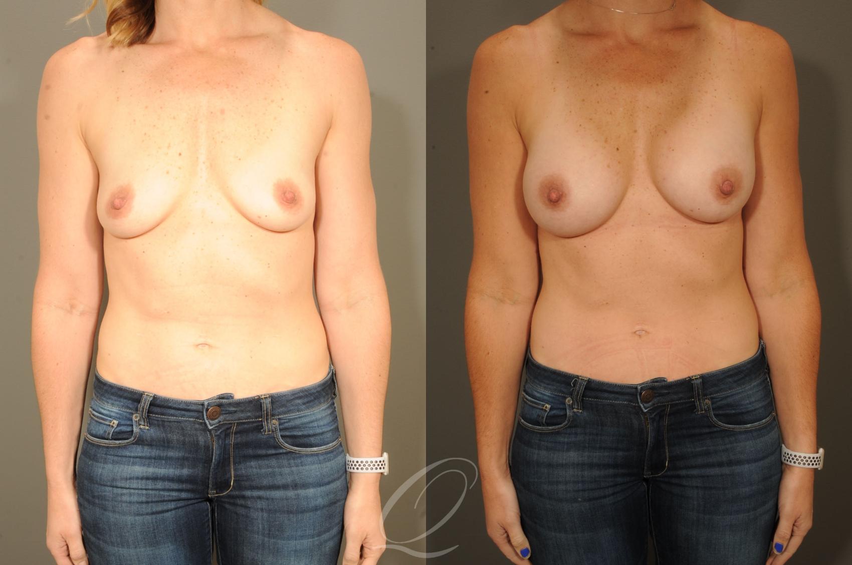 Breast Augmentation Case 318 Before & After View #1 | Serving Rochester, Syracuse & Buffalo, NY | Quatela Center for Plastic Surgery