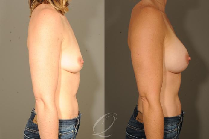 Breast Augmentation Case 318 Before & After View #2 | Serving Rochester, Syracuse & Buffalo, NY | Quatela Center for Plastic Surgery