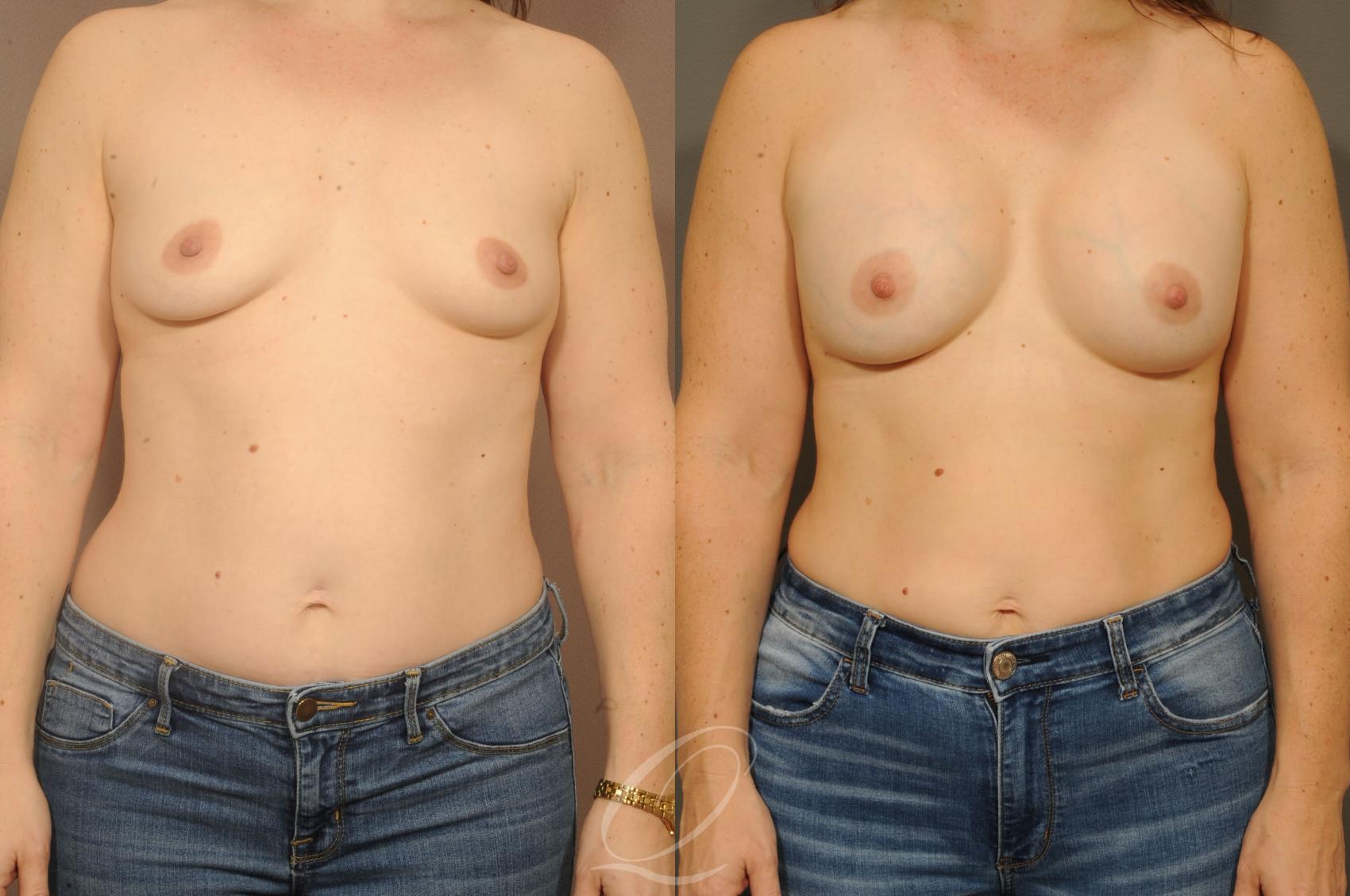 Breast Augmentation Case 319 Before & After View #1 | Serving Rochester, Syracuse & Buffalo, NY | Quatela Center for Plastic Surgery