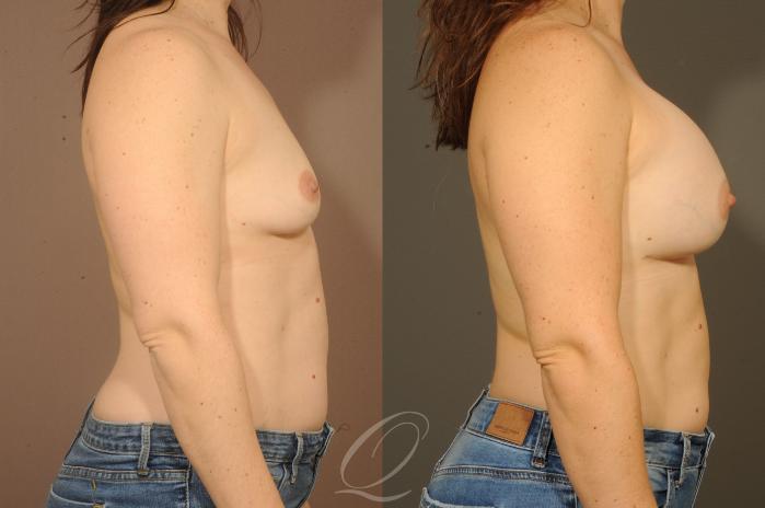 Breast Augmentation Case 319 Before & After View #2 | Serving Rochester, Syracuse & Buffalo, NY | Quatela Center for Plastic Surgery