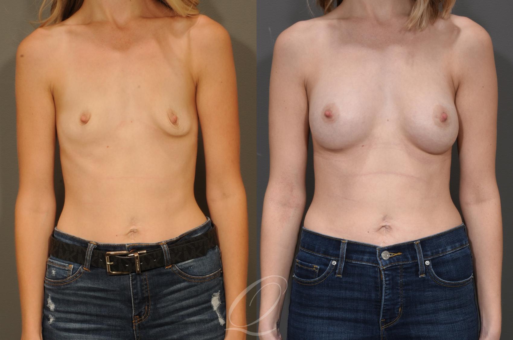 Breast Augmentation Case 324 Before & After View #1 | Serving Rochester, Syracuse & Buffalo, NY | Quatela Center for Plastic Surgery