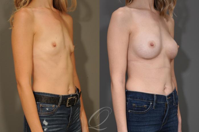 Breast Augmentation Case 324 Before & After View #2 | Serving Rochester, Syracuse & Buffalo, NY | Quatela Center for Plastic Surgery
