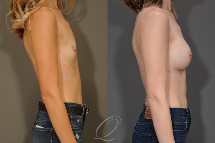 Breast Augmentation Case 324 Before & After View #3 | Serving Rochester, Syracuse & Buffalo, NY | Quatela Center for Plastic Surgery