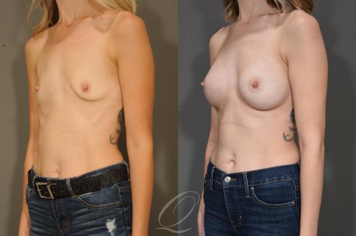 Breast Augmentation Case 324 Before & After View #4 | Serving Rochester, Syracuse & Buffalo, NY | Quatela Center for Plastic Surgery