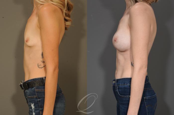 Breast Augmentation Case 324 Before & After View #5 | Serving Rochester, Syracuse & Buffalo, NY | Quatela Center for Plastic Surgery
