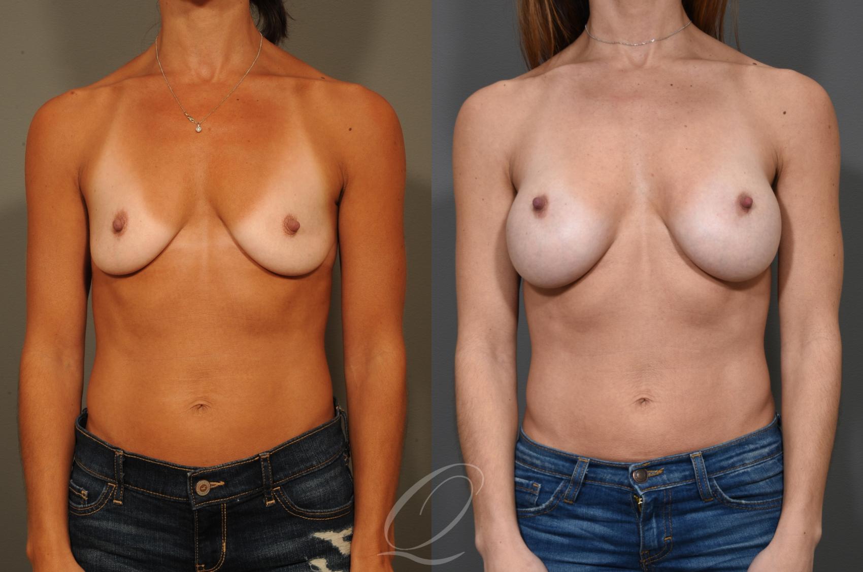 Breast Augmentation Case 325 Before & After View #1 | Serving Rochester, Syracuse & Buffalo, NY | Quatela Center for Plastic Surgery