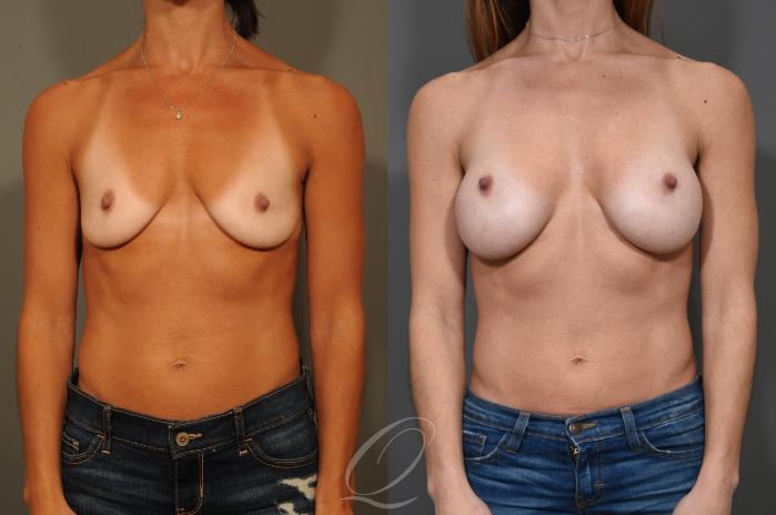 Breast Augmentation Case 325 Before & After View #1 | Serving Rochester, Syracuse & Buffalo, NY | Quatela Center for Plastic Surgery